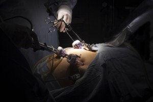 Is Gastric Sleeve Surgery Safe?